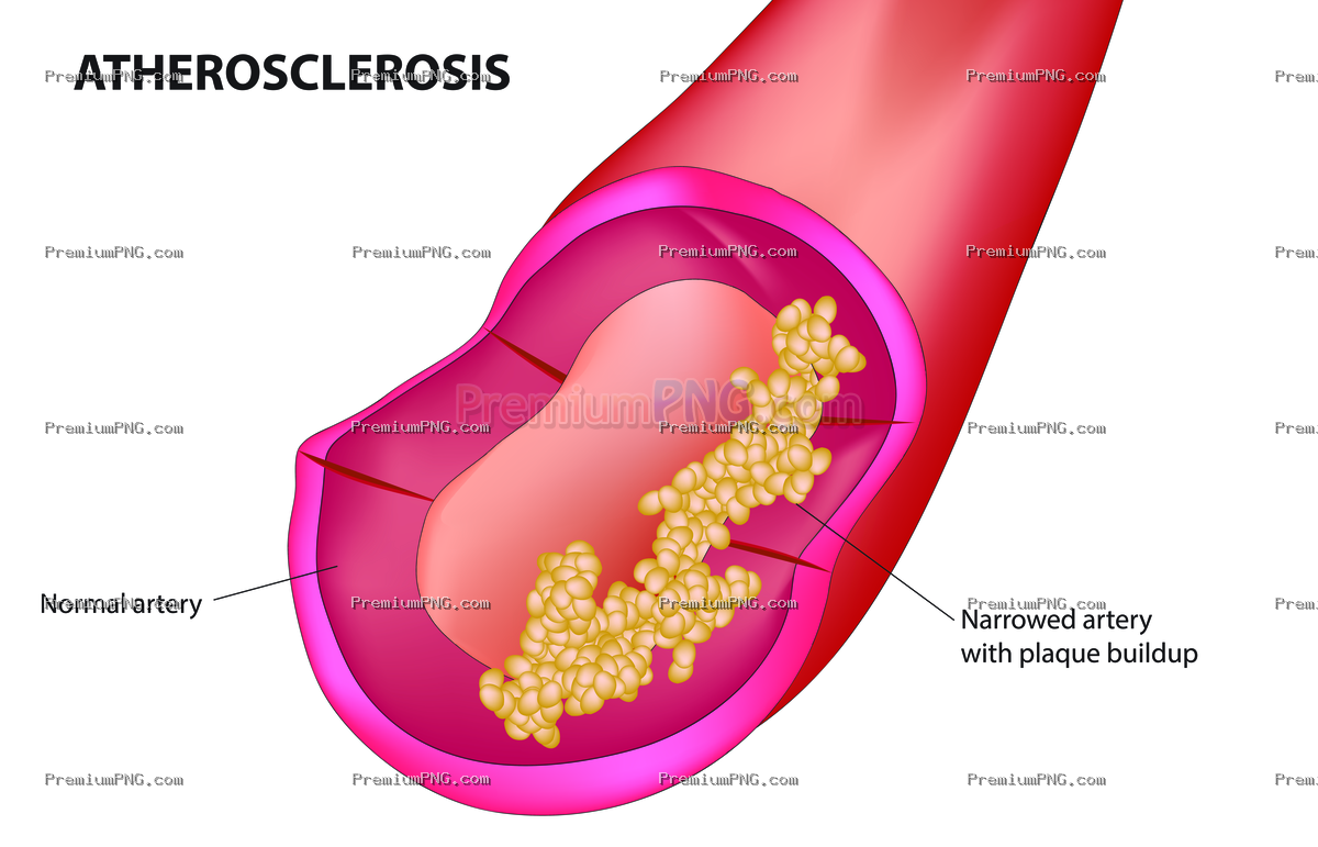 Atherosclerosis Vector EPS – Artery Plaque Medical Vector Illustration